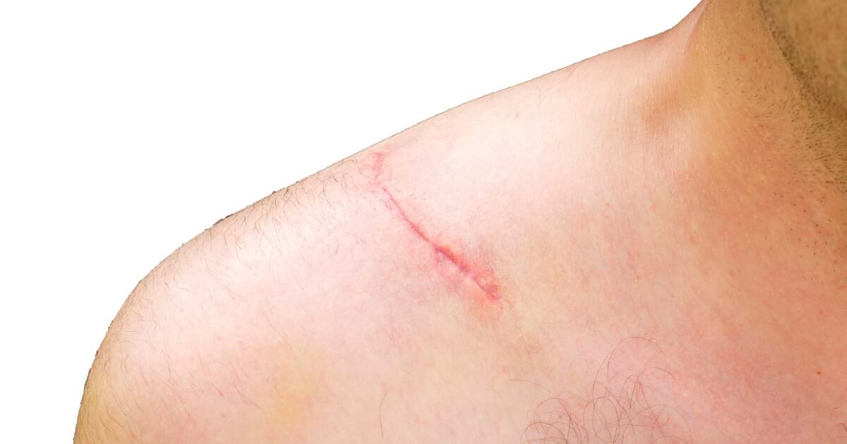 Scarring Claims Medical Negligence First4Lawyers